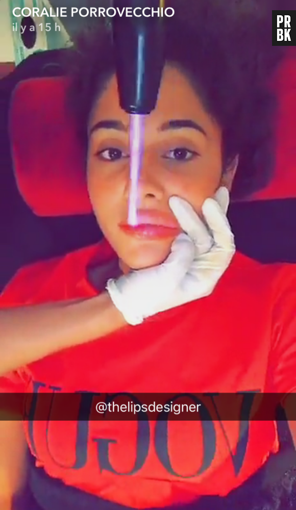 Coralie Porrovecchion montre son remodelage des lèvres sur Snapchat