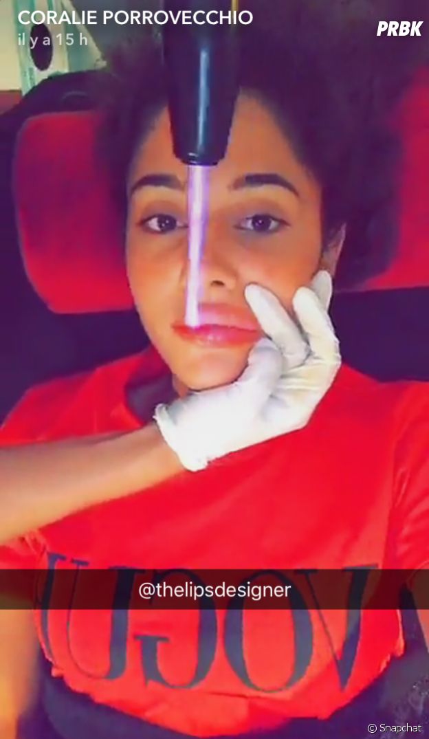 Coralie Porrovecchion montre son remodelage des lèvres sur Snapchat
