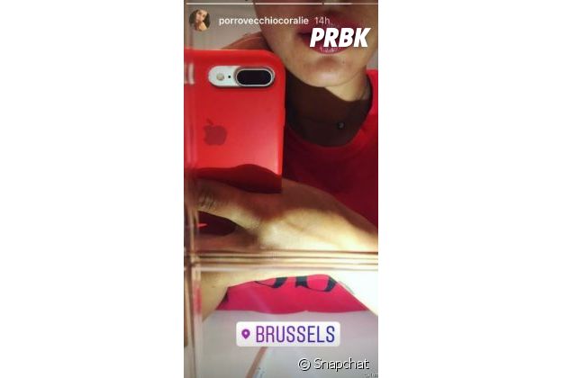 Coralie Porrovecchion montre son remodelage des lèvres sur Snapchat