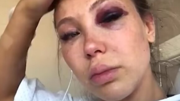 Andréane (Les Vacances des Anges 3) défigurée par un accident avec Rémi Notta, les images choc