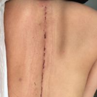 Emilie Fiorelli dévoile une cicatrice impressionnante après une lourde opération passée