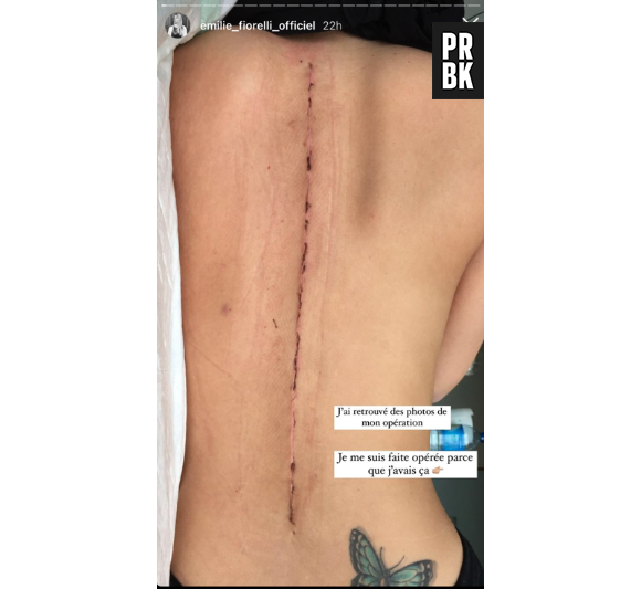 Emilie Fiorelli partage une photo de son impressionnante cicatrice post-opératoire.