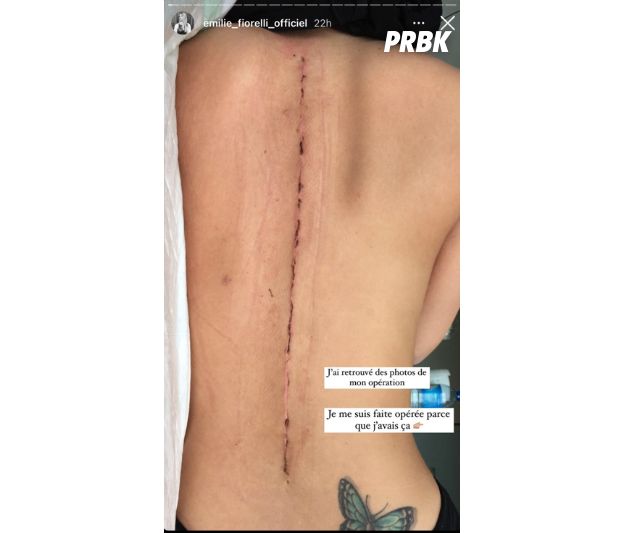 Emilie Fiorelli partage une photo de son impressionnante cicatrice post-opératoire.