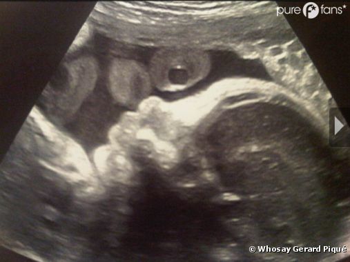 Shakira Enceinte Elle Lache La 1ere Photo De Son Bebe Et C Est Une Echographie Purebreak