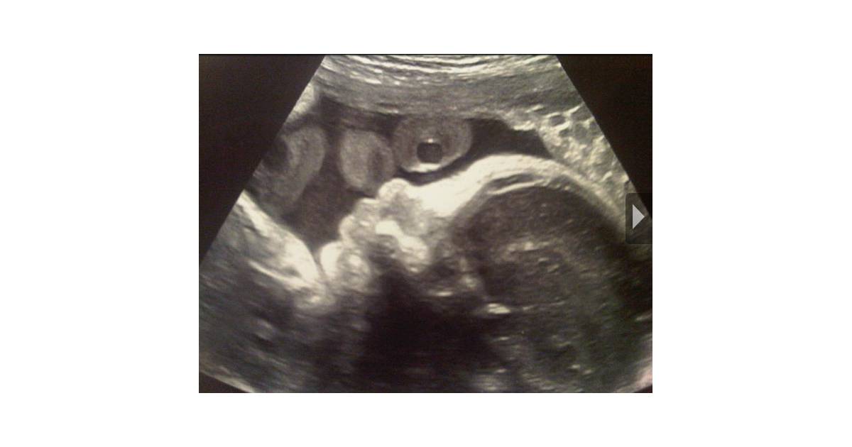 Shakira Enceinte Elle Lache La 1ere Photo De Son Bebe Et C Est Une Echographie Purebreak
