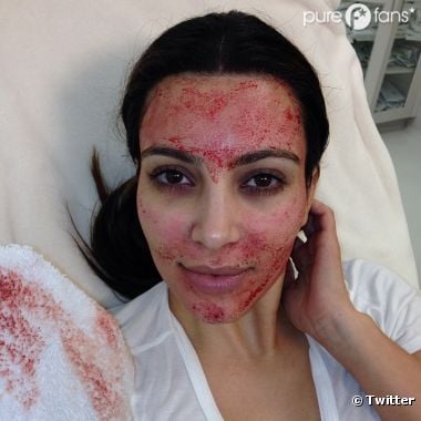 Kim Kardashian a opté pour un lifting sanglant.