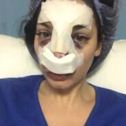 Nadège Lacroix couverte de bleus : sa photo choc après son opération de chirurgie du nez !