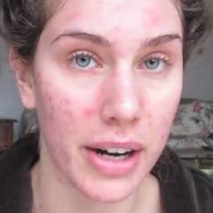 Cassandra Bankson : "Etre mannequin avec de l'acné, c'est possible !" (VIDEOS)