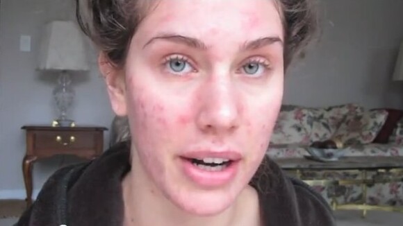 Cassandra Bankson : "Etre mannequin avec de l'acné, c'est possible !" (VIDEOS)
