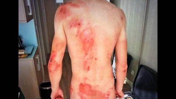 Tour de France 2013 : le cycliste Tony Martin nu sur Twitter... pour montrer ses blessures