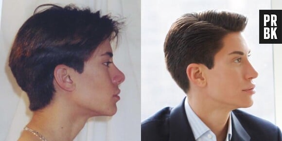 Justin Jedlica avant et après être devenu accro à la chirurgie esthétique.