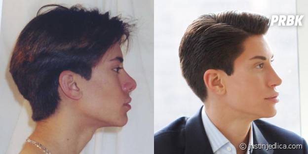 Justin Jedlica avant et après être devenu accro à la chirurgie esthétique.
