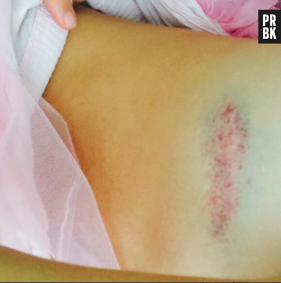 Cara Delevingne : Suki Waterhouse blessée à sa fête d'anniversaire