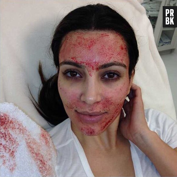 Kim Kardashian après sa séance de "vampire lift"