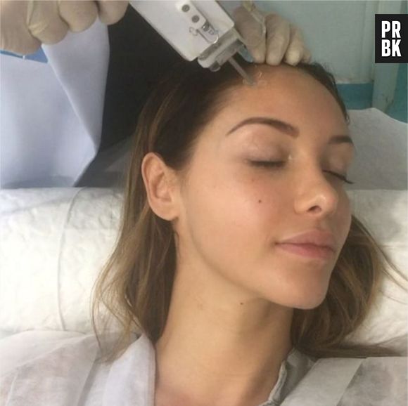 Nabilla Benattia accro au vampire lift comme Kim Kardashian