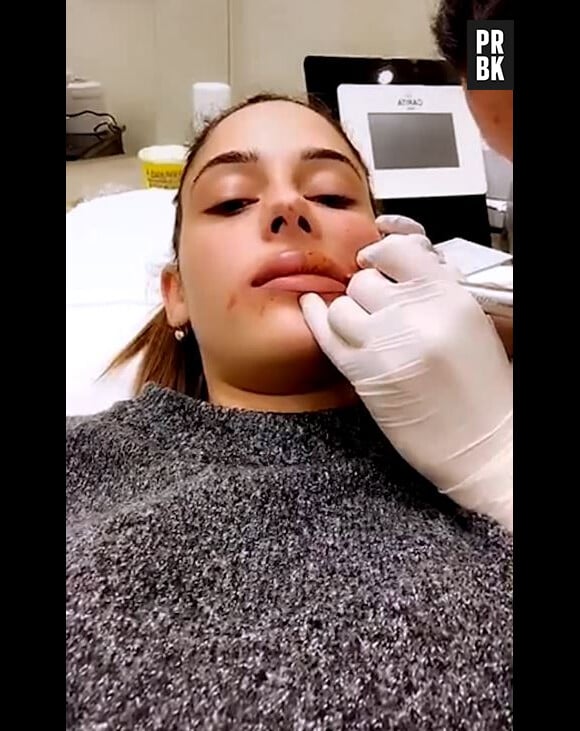 Coralie Porrovecchio : non ce n'est pas de la chirurgie esthétique, ses lèvres ont gonflé à cause de la micropigmentation.