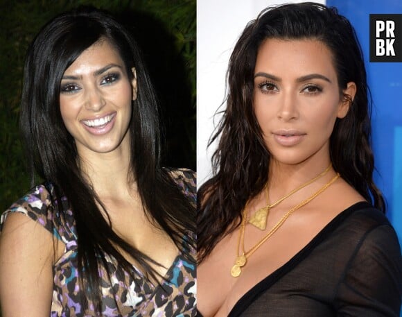 Kim Kardashian avant-après la chirurgie esthétique !