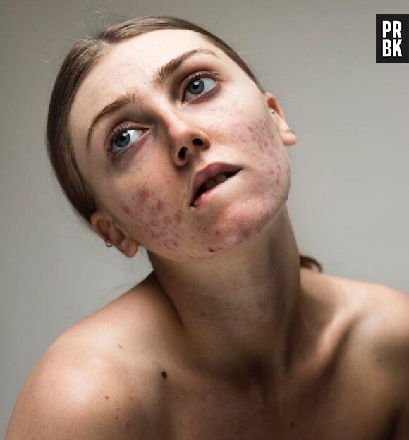 Ne complexez plus pour vos boutons d'acné grâce à la campagne #FreeThePimple !