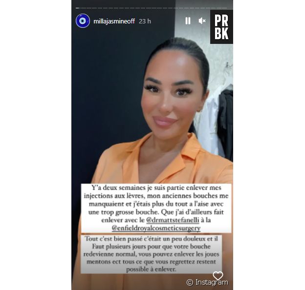 Milla Jasmine dévoile sa nouvelle opération de chirurgie esthétique au visage : des fossettes aux joues !
