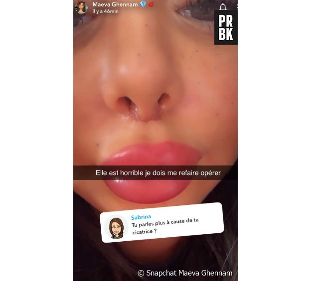 Maeva Ghennam annonce qu'elle va de nouveau subir une opération de chirurgie esthétique
