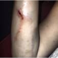 Kesha : une blessure au bras après son concert au Trianon