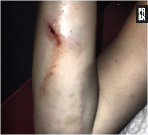 Kesha : une blessure au bras après son concert au Trianon