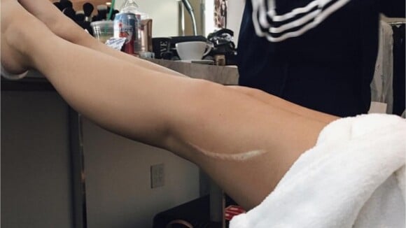 Kylie Jenner dévoile son énorme cicatrice "causée" par Kendall