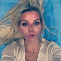 Jessica Thivenin (Les Marseillais) : le visage en sang, elle s&#039;affiche sur Instagram