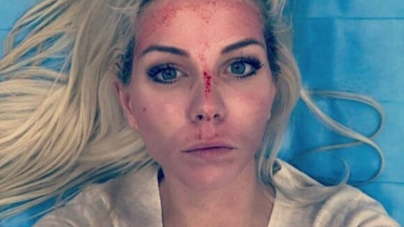 Jessica Thivenin (Les Marseillais) : le visage en sang, elle s'affiche sur Instagram