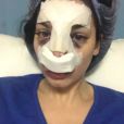  Nadège Lacroix : ses photos choc après son opération du nez 