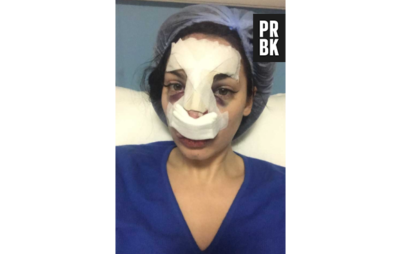 Nadège Lacroix : ses photos choc après son opération du nez