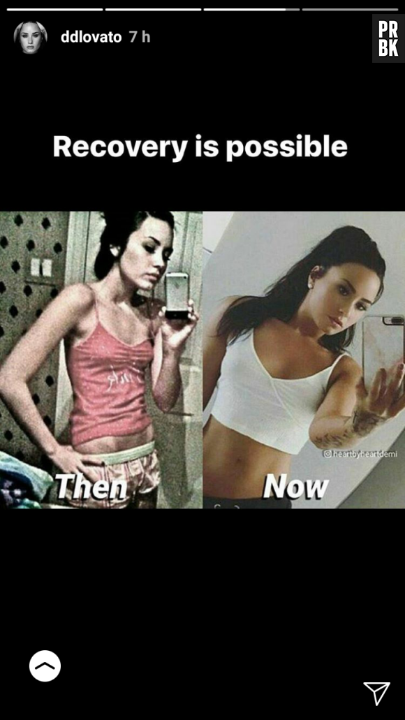 Demi Lovato avant/après ses problèmes de boulimie : la photo choc