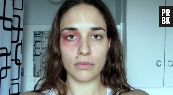 Sous les coups de son conjoint, les bleus envahissent son visage (vidéo postée le 18 mars 2013 sur Youtube)