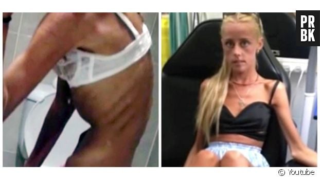   Christie Swadling raconte en vidéo comment elle a sombré dans l&#039;anorexie avant d&#039;en guérir.  