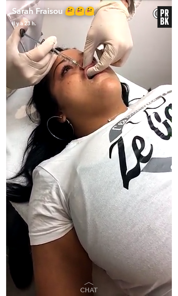 Sarah Fraisou se fait des injections dans les lèvres et filme tout sut Snapchat