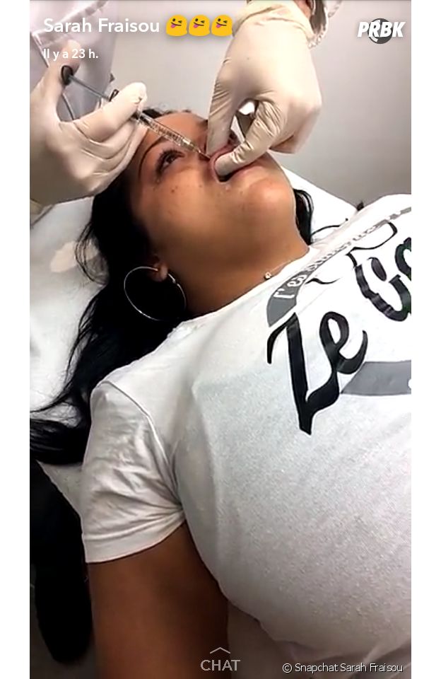 Sarah Fraisou se fait des injections dans les lèvres et filme tout sut Snapchat