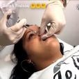 Sarah Fraisou se fait des injections dans les lèvres en direct sur Snapchat