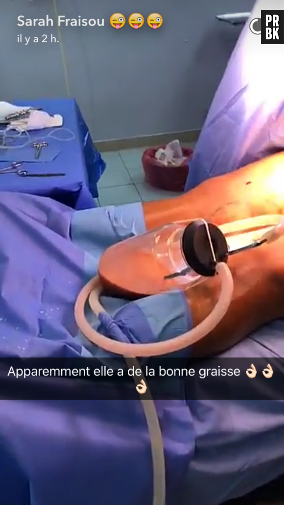 Sarah Fraisou filme (encore) sa nouvelle opération de chirurgie esthétique sur Snapchat !