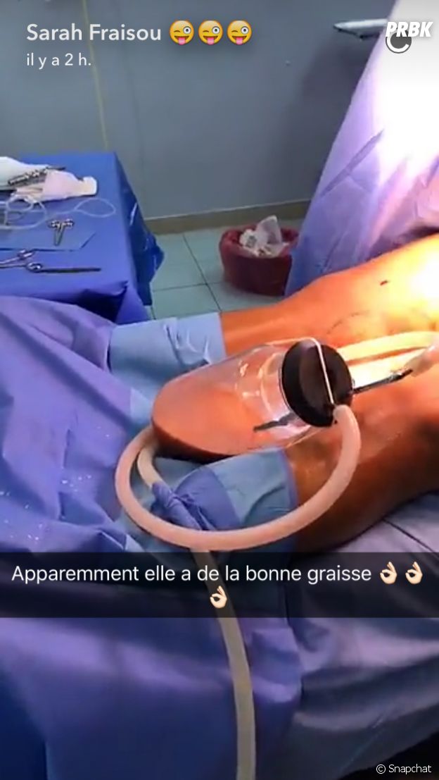 Sarah Fraisou filme (encore) sa nouvelle opération de chirurgie esthétique sur Snapchat !