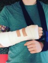 Ed Sheeran se dévoile le bras dans le plâtre sur Instagram