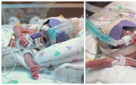 Premature De 4 Mois Ce Bebe Fragile Et En Pleine Detresse Va Vous Serrer Le Coeur Purebreak